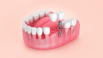 Dental Bridge vs. Dental Implant: What’s Your Preference?